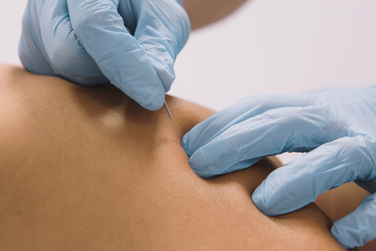 Two hands wearing blue gloves performing dry needling on a person’s skin in Bethesda.