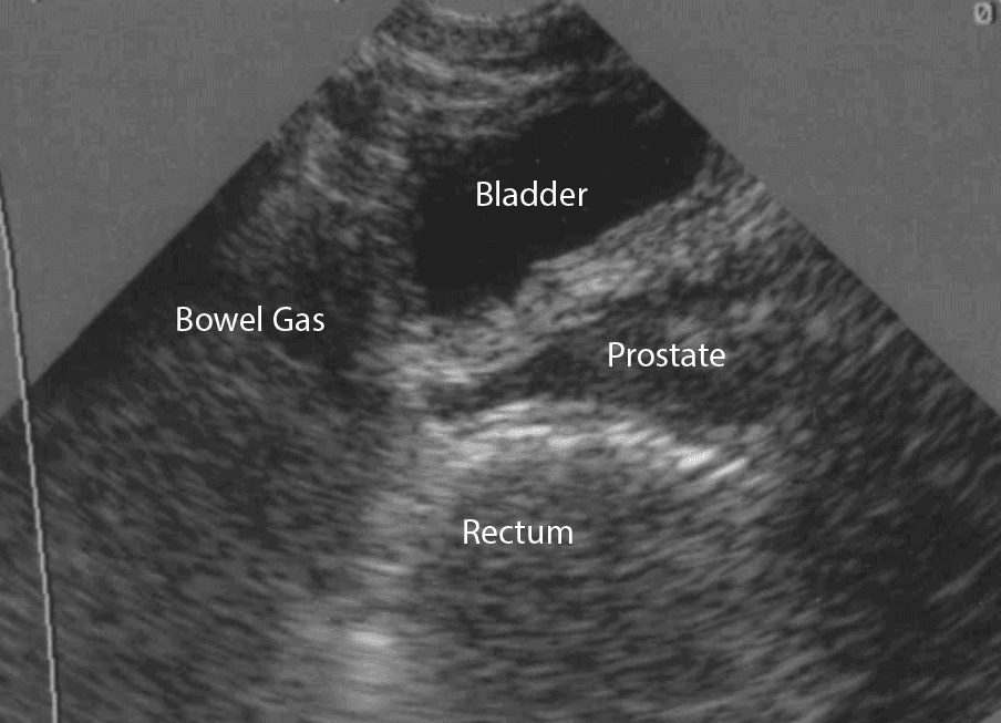 Ultrasound examination of the bladder and pelvic organs