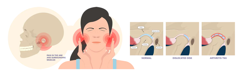Temporomandibular Joint Disorders TMD TMJ treat pain displaced disc temporal bone locking bite plate plastic guard night